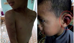 Những hình ảnh xót xa trong vụ bé trai bị sư thầy đánh bầm tím người ở Thanh Hóa