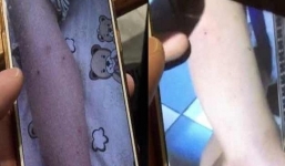 Phụ huynh tố giáo viên mầm non dùng tăm đâm vào người trẻ để trừng phạt