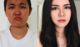 Choáng váng với nhan sắc của nữ sinh Thương Mại sau phẫu thuật thẩm mỹ