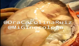 Chào đời nhưng em bé vẫn ngủ ngon lành trong túi ối, mặc kệ mọi người xung quanh