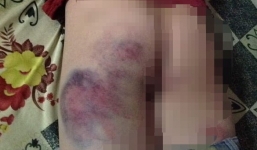 Đắk Lắk: Giáo viên cầm vật cứng đánh bầm tím mông học sinh do không viết được bài