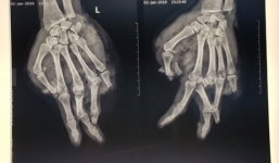 Bình gas mini phát nổ khi ăn lẩu, nam thanh niên dập nát nguyên bàn tay