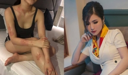 Tin tức giải trí mới nhất ngày 8/1/2019: Hương Tràm bị bệnh nặng, nổi mẩn khắp người