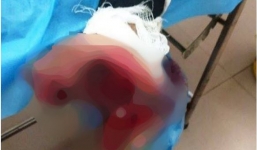 Nam thanh niên dập nát bàn tay vì sử dụng điện thoại khi đang sạc