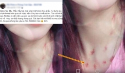 Nam thanh niên bẽ bàng phát hiện mình bị 'cắm sừng' sau khi hỏi những vết đỏ trên cổ bạn gái