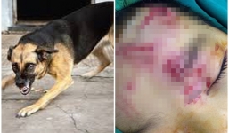 Nam Định: Bé gái 6 tuổi bị chó nhà 30kg cắn trọng thương vùng mặt