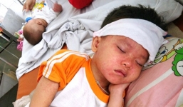 Hà Nội: Một tuần ghi nhận 23 ca mắc sởi, cảnh báo dịch sởi tăng nhanh và khó lường