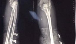 Nam thanh niên bị cụt 2 bàn tay vì tự chế pháo nổ ngày cận Tết Kỷ Hợi