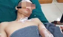 Hàng chục người nhập viện cấp cứu do đốt pháo trong đêm giao thừa