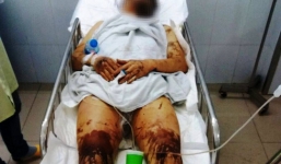 Việt kiều bị tạt axit, cắt gân chân khi về quê ăn Tết gây rúng động Quảng Ngãi