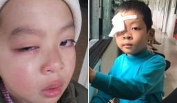Lạng Sơn: Nghi vấn học sinh tiểu học bị chấn thương mắt nghi do cô giáo dùng thước đánh