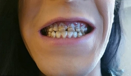 Hy hữu: Nghiện nước tăng lực, nam sinh 21 tuổi gãy hết răng