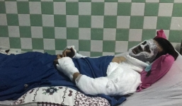 Vụ Việt kiều bị tạt axit: Mặt bị bỏng 90\%, mắt không thể mở hoàn toàn