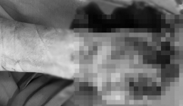 Thiếu niên phải cắt cụt tay do điện thoại phát nổ khi đang sạc