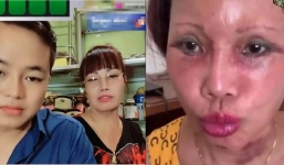 Cô dâu Cao Bằng xuống cấp nhan sắc: Miệng méo, mí sụp hậu thẩm mỹ