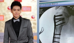 Lâm Chí Dĩnh tiết lộ ảnh cận bàn tay bị chấn thương vì tai nạn khiến ai cũng xót xa