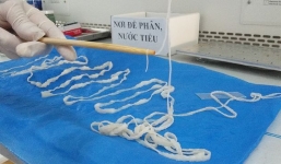 Cô giáo hoảng hồn phát hiện sán dây dài hơn 5 mét trong cơ thể