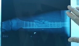 Nghi cảnh sát 113 bắn trọng thương người dân vì cho rằng ngáo đá