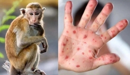 Việt Nam ghi nhận 56 ca đậu mùa khỉ, Bộ Y tế đề nghị tiếp tục giám sát