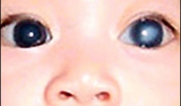 Bé 3 tuổi có màu mắt bất thường, đi khám mới biết mắc bệnh nguy hiểm