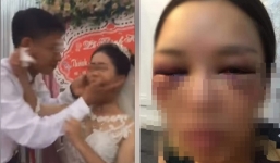Thực hư bức ảnh cô dâu bị đánh tím mắt vì 'thái độ' với chồng ngay trong đám cưới