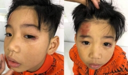 Con trai siêu mẫu Hạ Vy bị tai nạn rách mắt, chấn thương sọ não