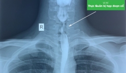 Đà Nẵng: Uống nhầm chất tẩy rửa, nam thanh niên bị bỏng thực quản