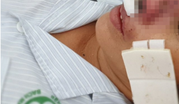 Vi khuẩn Whitmore tấn công, ăn mòn cánh mũi của bệnh nhân