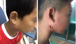 Bộ Y tế hướng dẫn cách phòng ngừa 'vi khuẩn ăn thịt người'