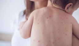 WHO công bố tình trạng y tế toàn cầu đối với bệnh đậu mùa khỉ: Bộ Y tế họp khẩn