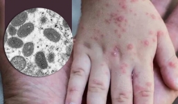 WHO công bố tình trạng y tế toàn cầu đối với bệnh đậu mùa khỉ: Bộ Y tế khuyến cáo 6 biện pháp phòng chống