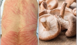 Ăn nấm hương chưa nấu chín, người đàn ông bị phát ban đau đớn suốt hai ngày