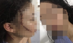 Xôn xao vụ việc thiếu nữ 18 tuổi bị bạn rạch mặt ở Bắc Ninh