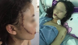 Công an chính thức thông tin vụ 2 thiếu nữ rạch mặt kinh hoàng ở Bắc Ninh