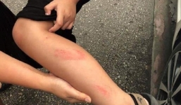 Xôn xao cô giáo tát học sinh lớp 2 tím thái dương trong giờ kiểm tra học kỳ