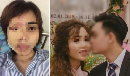 Thiếu úy công an tạt a xít vợ chưa cưới đối diện với mức án nào?