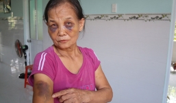 Công an lên tiếng về vụ con dâu đánh mẹ chồng bầm tím mặt