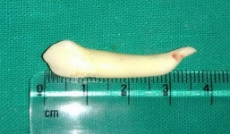 Đi nhổ răng, người đàn ông giật mình phát hiện điều phi thường