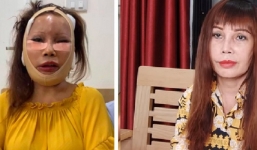 Cô dâu 63 tuổi lộ khuôn mặt lạ lẫm sau 2 tháng phẫu thuật căng da 