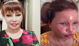 'Cô dâu 62 tuổi' ở Cao Bằng gây sốc khi lộ mặt méo xệch hậu phẫu thuật thẩm mỹ