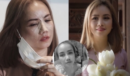 Cận mặt diễn viên Hoàng Yến sau khi bị chồng cũ 'đi đường quyền' hỏng mũi
