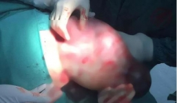 Hy hữu bé gái hơn 3kg chào đời còn nguyên túi ối