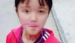 Con gái có nhiều vết bầm trên cổ và sự thật đau đớn phía sau