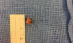 Thấy con khóc lóc, mẹ tá hoả phát hiện thứ này trong tai suốt 9 năm