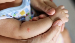 5 mẹo chữa muỗi đốt cho trẻ em cực đơn giản