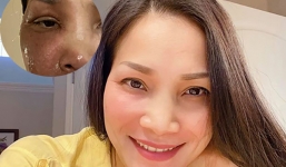 Hồng Ngọc và nhan sắc hồi phục kỳ diệu sau vụ bỏng, vẫn còn lộ vết thương khó lành