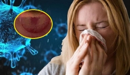 Triệu chứng mới của Covid-19 các chuyên gia cảnh báo không nên xem thường