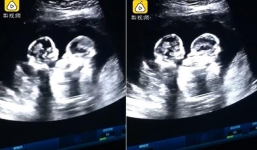 Cặp song sinh gây sốt mạng xã hội khi đánh nhau chí choé trong bụng mẹ