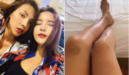 Kỳ Duyên để lộ đôi chân bầm tím sau thời gian 'mất tích' cùng Minh Triệu