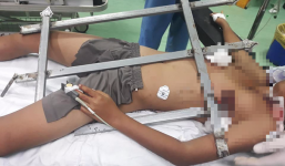 Ngã cây khi chơi cùng bạn, thiếu niên bị chông hàng rào đâm dọc ngực